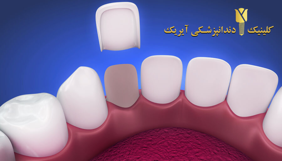 عمر لمینت دندان