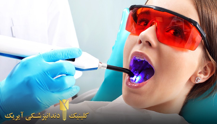 انواع سفید کردن دندان