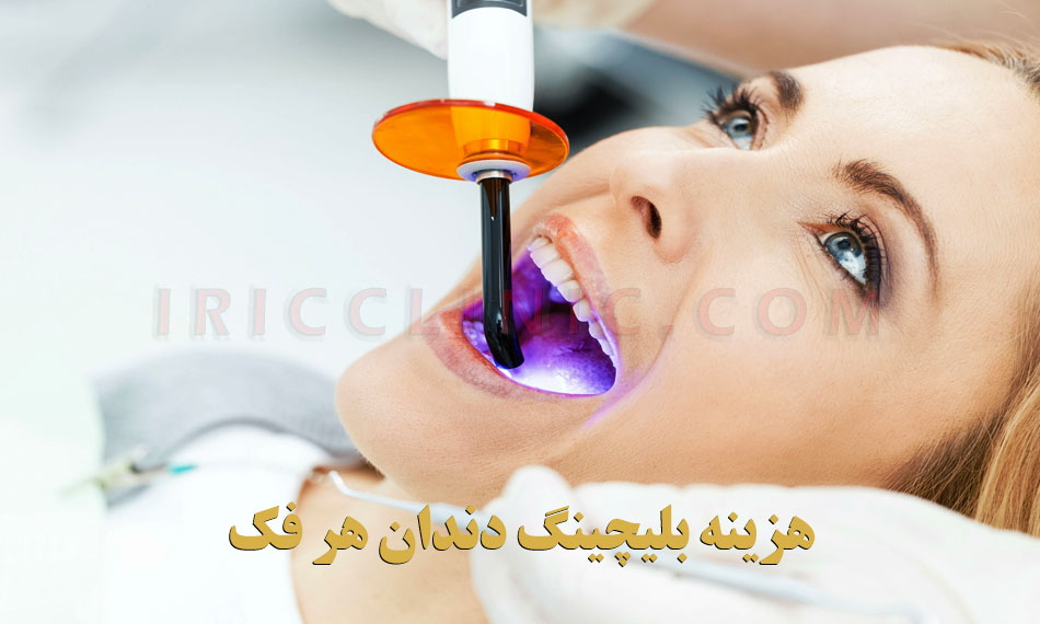 بلیچینگ دندان در مطب
