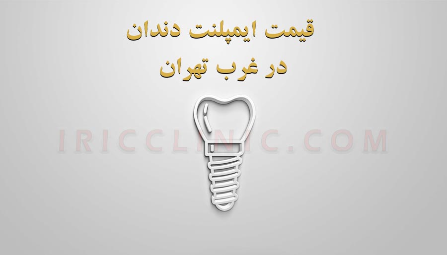 قیمت ایمپلنت دندان در غرب تهران