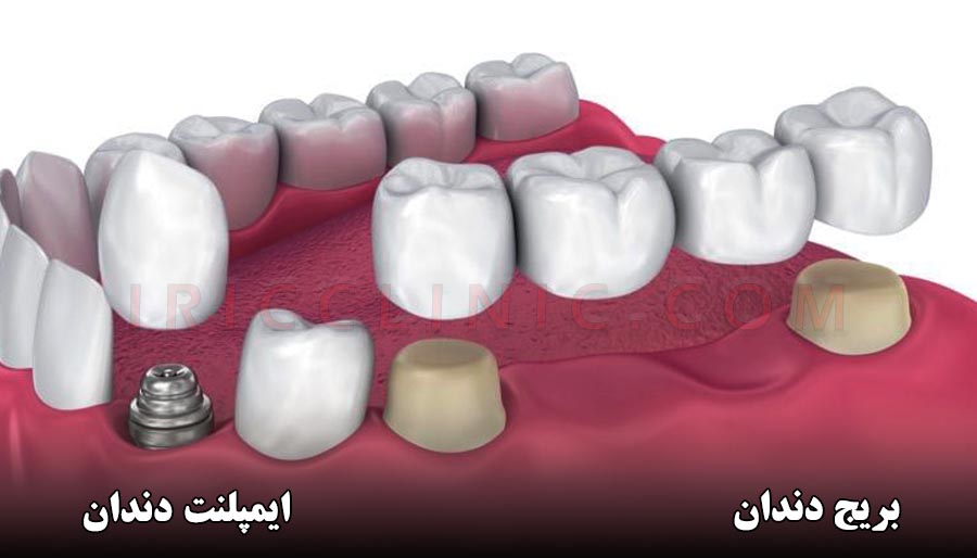 عکس تفاوت بریج دندان با ایمپلنت دندان