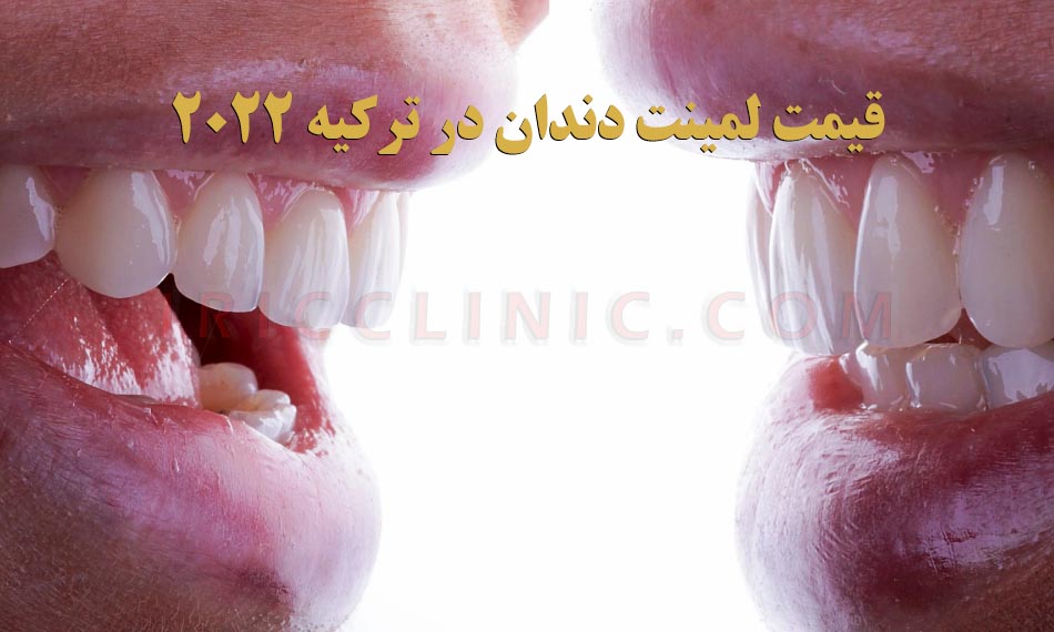عکس لمینت دندان در ترکیه
