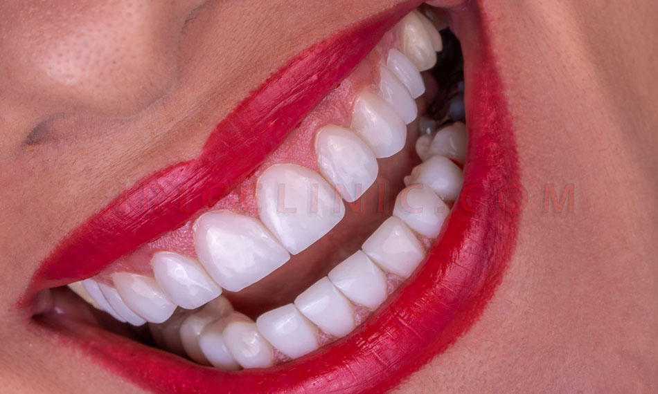 عکس کامپوزیت دندان ونیر
