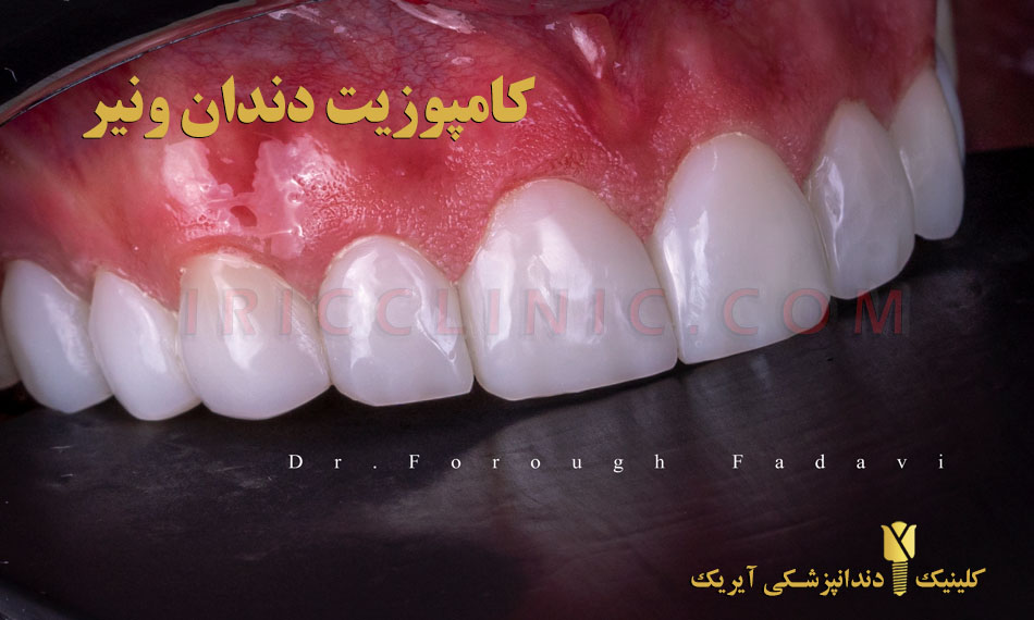 کامپوزیت دندان ونیر