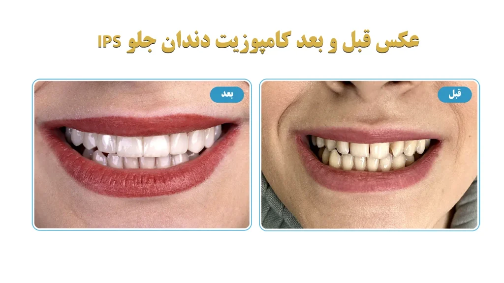 عکس قبل و بعد کامپوزیت دندان